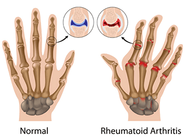 rheumatoid-arthritis